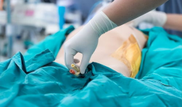 插尿管视频,专业操作与注意事项